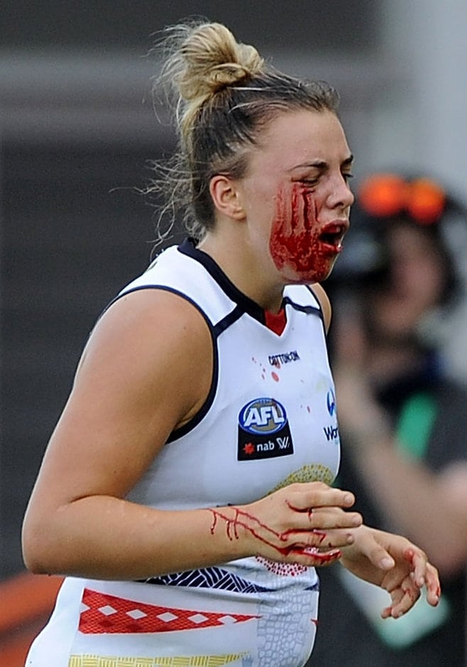AFLW 2018 Rd 06 - Adelaide v Fremantle DARWIN, AUSTRALIA - MARCH 9: Ebony Marinoff of the Crows leaves the ground bleeding during the 2018 AFLW Round 06 match between the Adelaide Crows and the Fremantle Dockers at TIO Stadium on March 9, 2018 in Darwin, Australia. (Photo by Felicity Elliott/AFL Media)